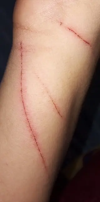 close-up of human arm with fresh red cat play scratch marks (accidental scratches from feline interaction)