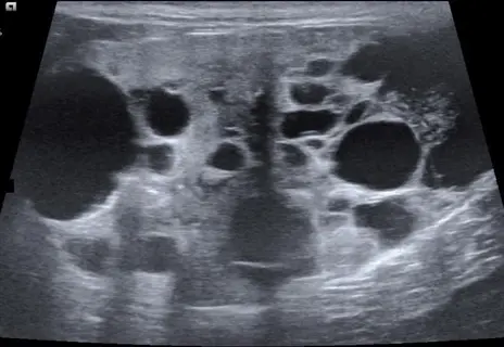 veterinary ultrasound showing cystic renal changes in a cat - potential indicator of polycystic kidney disease (common cause of cat kidney failure)